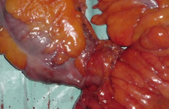 APPENDICULAR - SIGMOID FISTULA