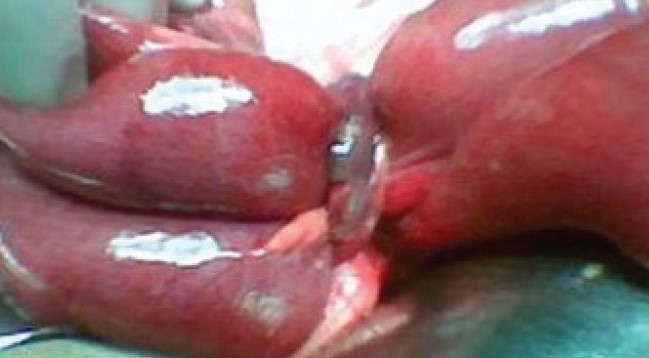 APPENDICULAR KNOT 