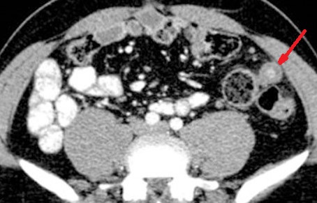 LEFT SIDED APPENDIX