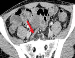 PELVIC APPENDIX