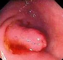 INVERTED APPENDICULAR STUMP