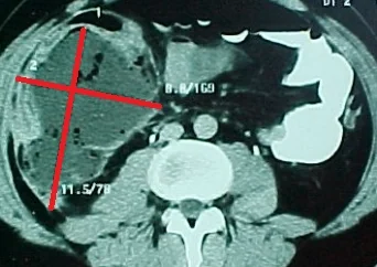 APPENDICULAR ABSCESS