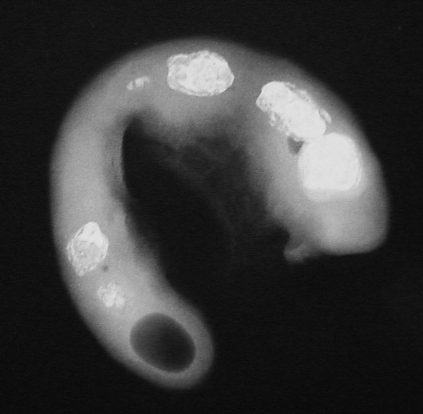 APPENDICULAR FAECALITHS