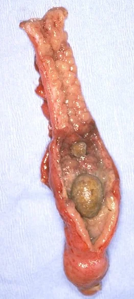 APPENDICULAR FAECALITHS
