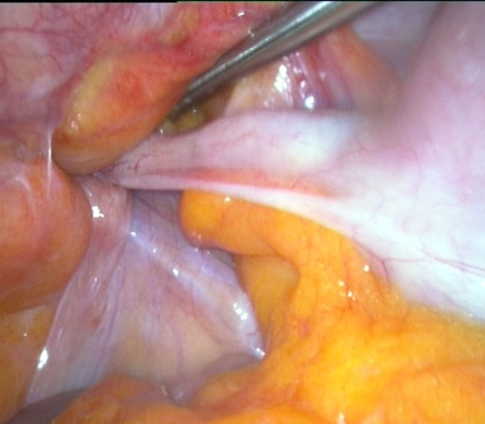 APPENDIX IN THE INGUINAL CANAL