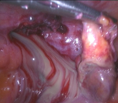 APPENDIX REMOVED FROM THE INGUINAL CANAL