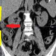 SUBHEPATIC APPENDIX