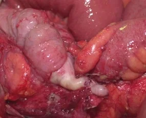 APPENDICULAR CARCINOID