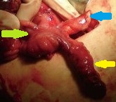 DOUBLE CAECAL APPENDIX