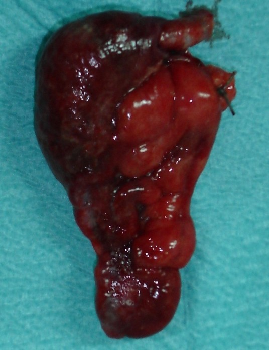 GANGRENOUS APPENDICITIS