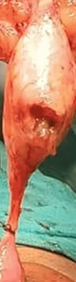 HYPERPLASTIC APPENDIX