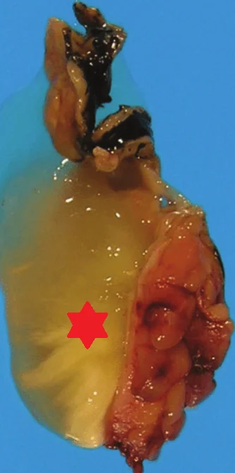 MUCINOUS ADENOCARCINOMA