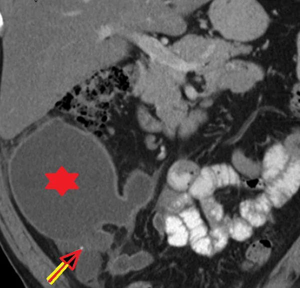 MUCINOUS ADENOCARCINOMA