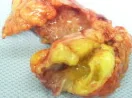 MUCINOUS CYSTADENOCARCINOMA