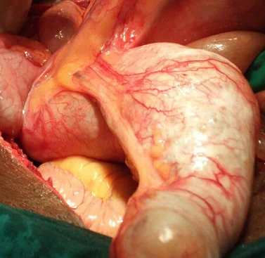 MUCINOUS CYSTADENOMA