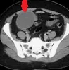 MUCINOUS CYSTADENOMA