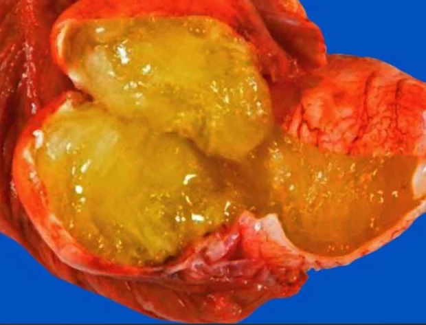 HYPERPLASTIC MUCOCELE