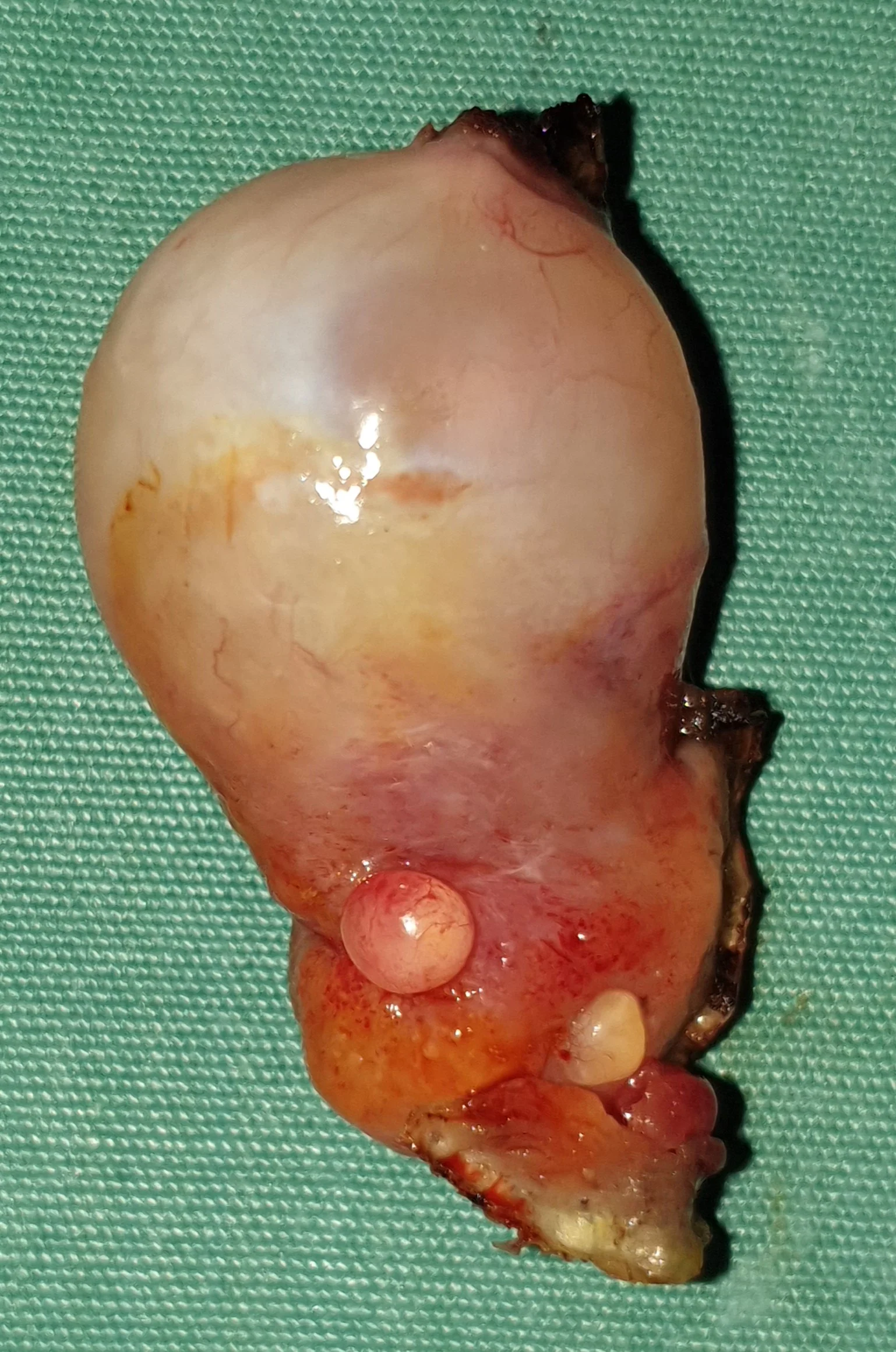 APPENDICULAR MUCOCELE