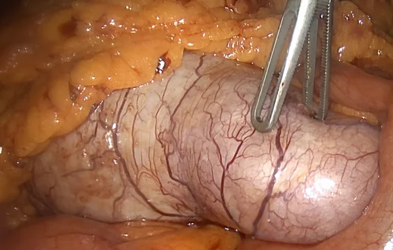 APPENDICULAR MUCOCELE