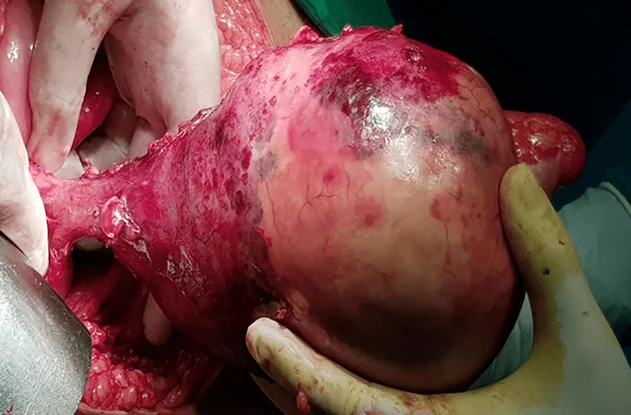 APPENDICULAR MUCOCELE