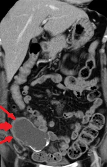 APPENDICULAR MUCOCELE
