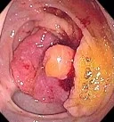 PERIAPPENDICULAR CARCINOMA