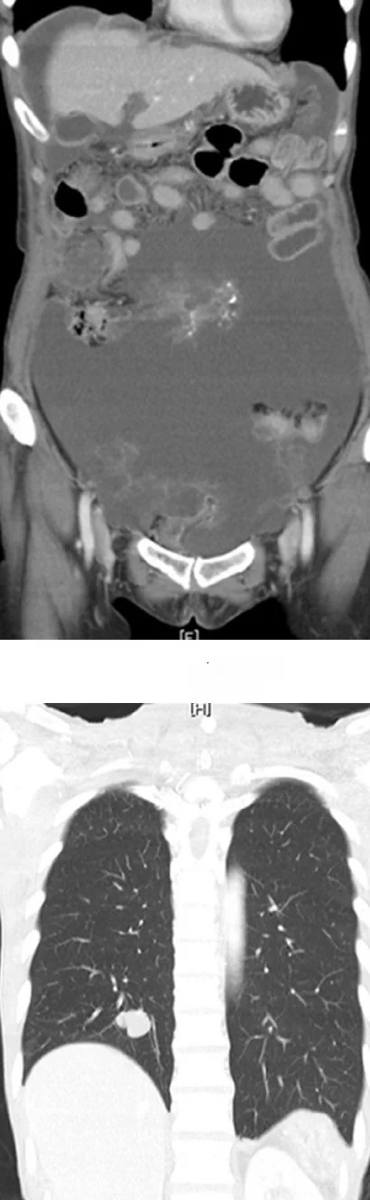 PSEUDOMYXOMA PERITONEI - LUNG METASTASES