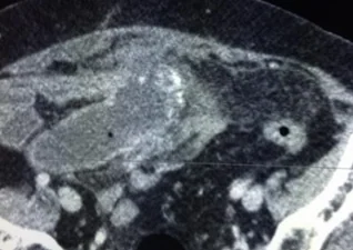 RETENTION MUCOCELE