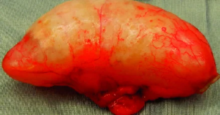 RETENSION MUCOCELE