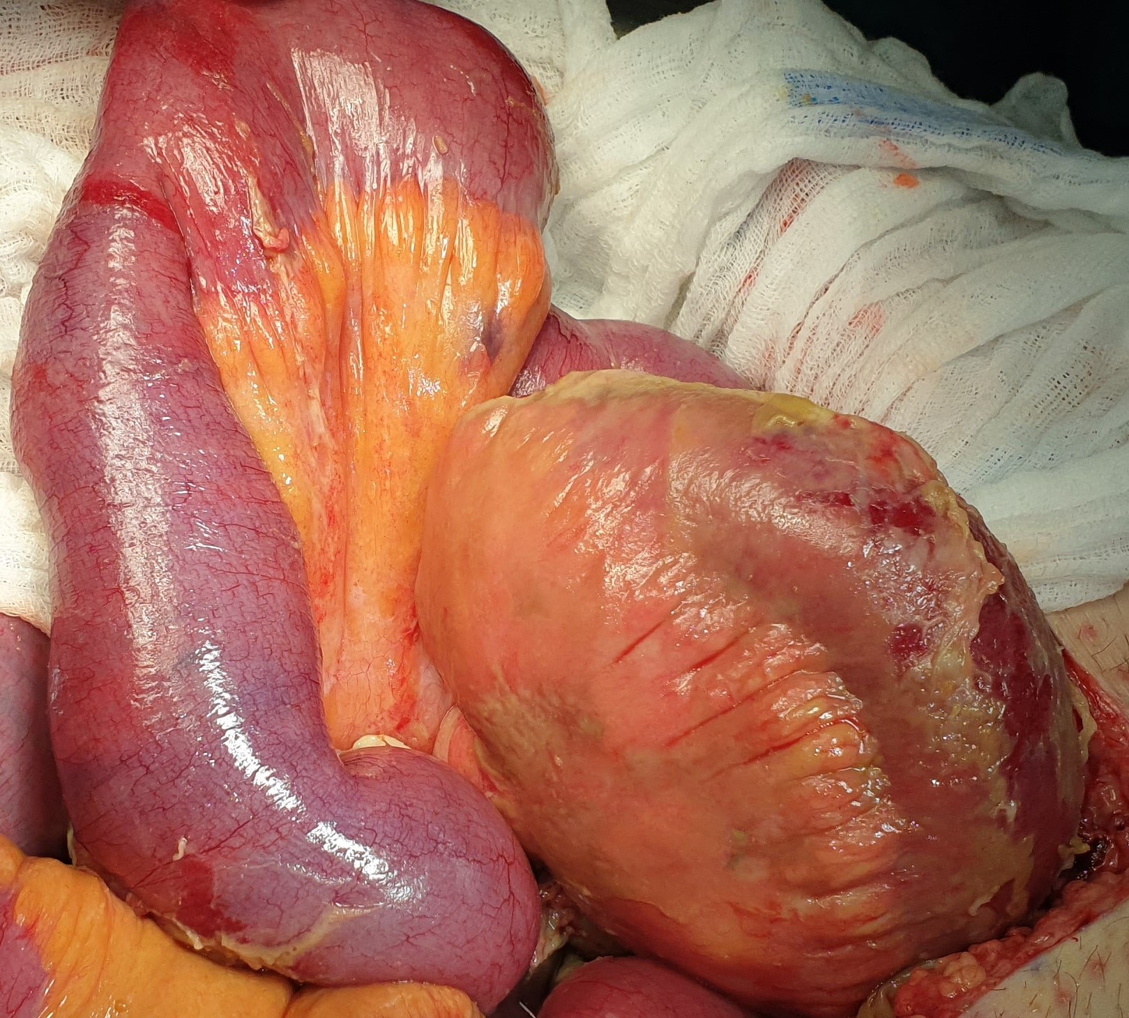 ISCHAEMIC ENTERITIS