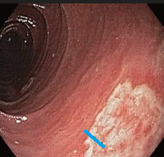 CLOSTIRIDIUM DIFFICILE ENTERITIS