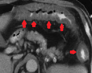 ISCHAEMIC COLITIS