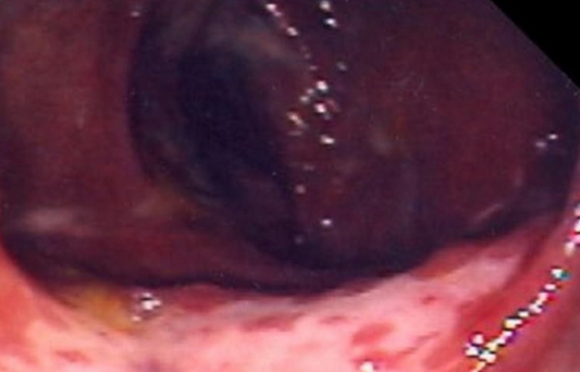 ISCHAEMIC COLITIS