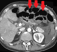 NON OCCLUSIVE ISCHAEMIC DISEASE