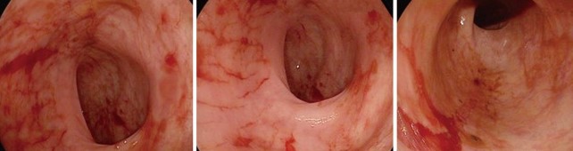 CAT-SCRATCH COLITIS 