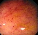 CMV COLITIS 
