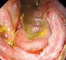 CMV COLITIS 
