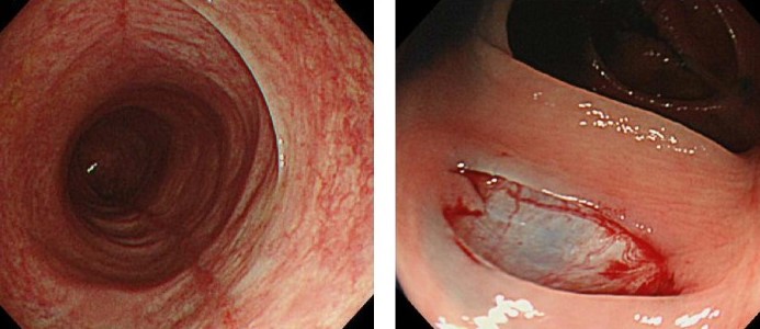 COLLAGENOUS COLITIS ULCERS