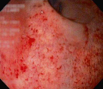DIVERSION COLITIS