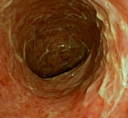 DIVERSION COLITIS