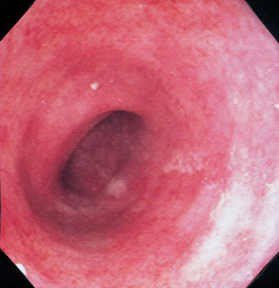 DIVERSION COLITIS