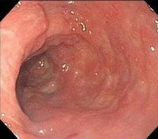 DIVERSION COLITIS