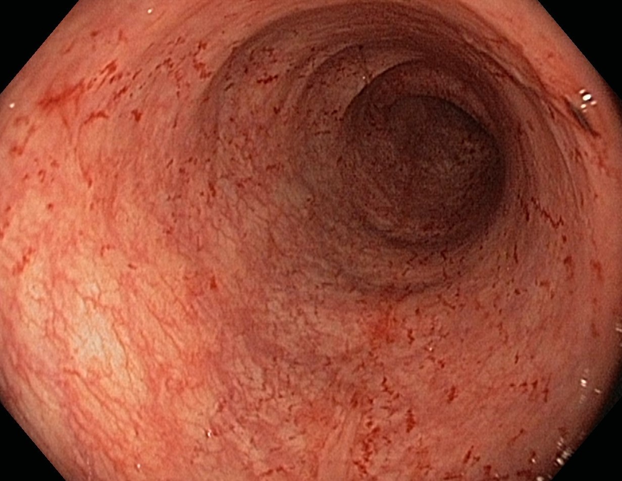 DIVERSION COLITIS