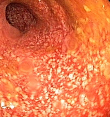DIVERSION COLITIS