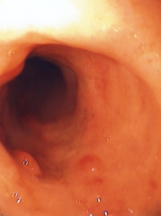 EOSINOPHILIC COLITIS 