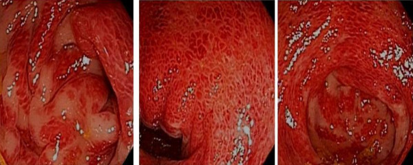 HENOCH SCHOLEIN PURPURA - VASCULITIS COLITIS 