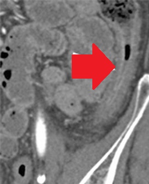 ISCHAEMIC COLITIS