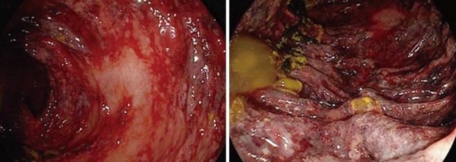 ISCHAEMIC COLITIS