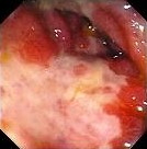 ISCHAEMIC COLITIS