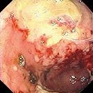ISCHAEMIC COLITIS 